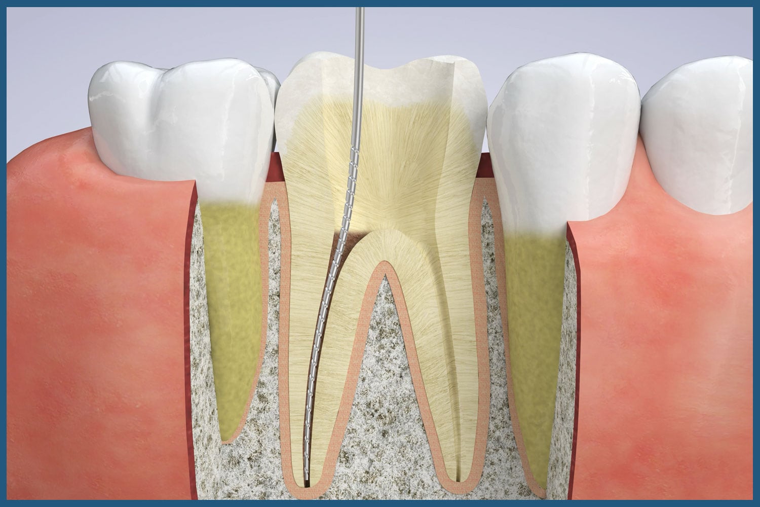 Stages of Root Canal Therapy in South Kingstown, RI